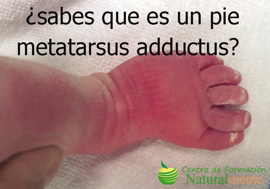 Pie metatarsus adductus