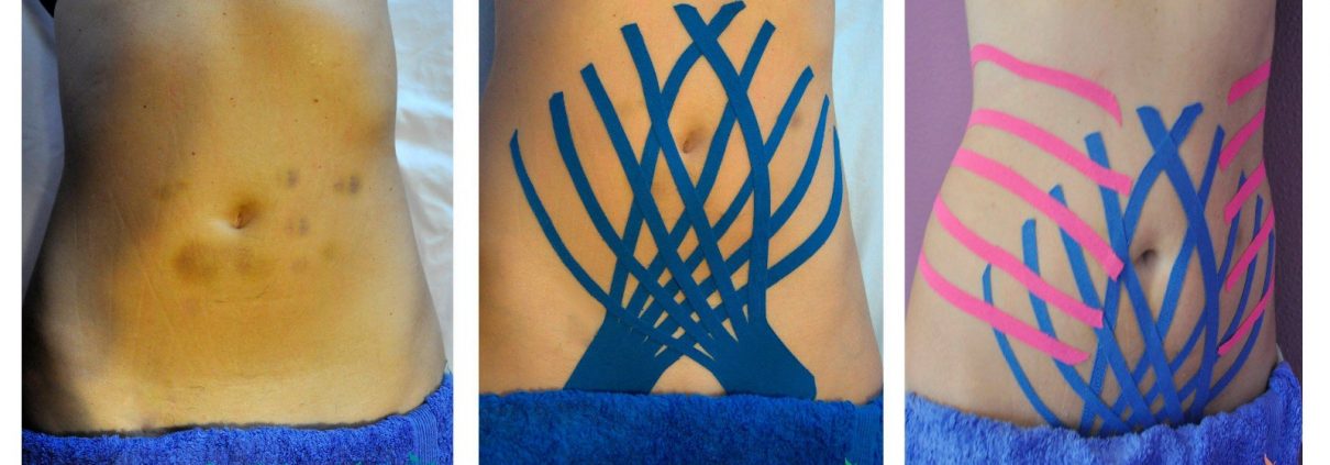 La mesoterapia y el kinesiotaping